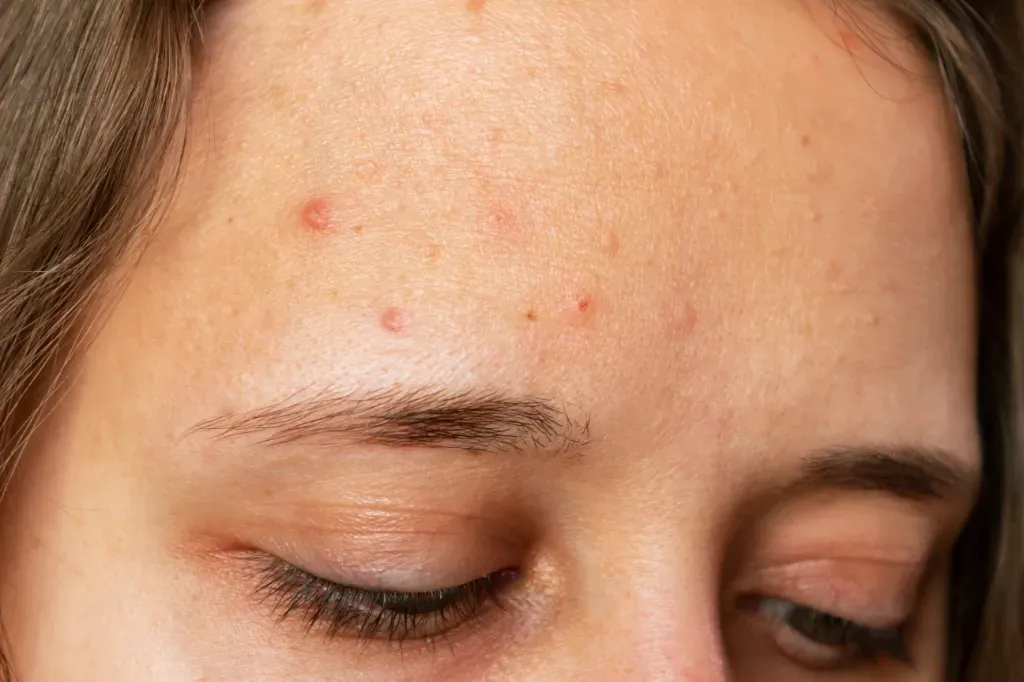 Trądzik młodzieńczy